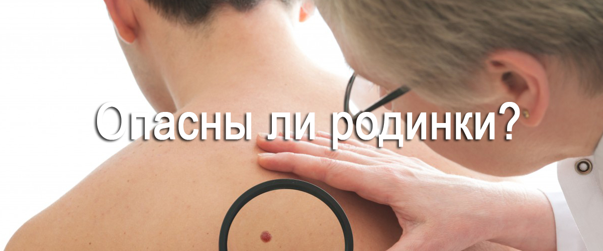 опасны ли родинки?