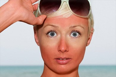 первая помощь при солнечных ожогах