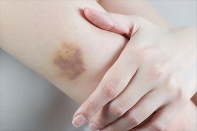 почему часто появляются синяки?